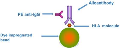 Detection of HLA Antibodies in Organ Transplant Recipients – Triumphs and Challenges of the Solid Phase Bead Assay